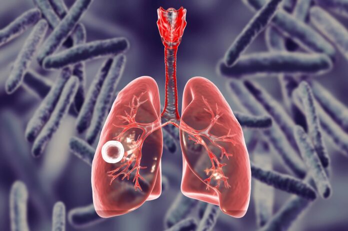 tuberculosis-1
